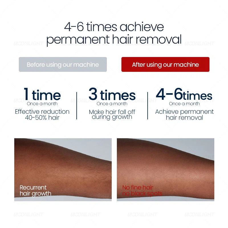 AI Diode Laser Hair Removal Machine With Android 12 System