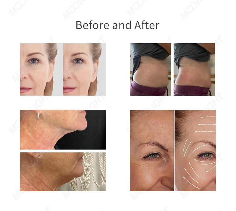 Cryoskin Machine Treatment