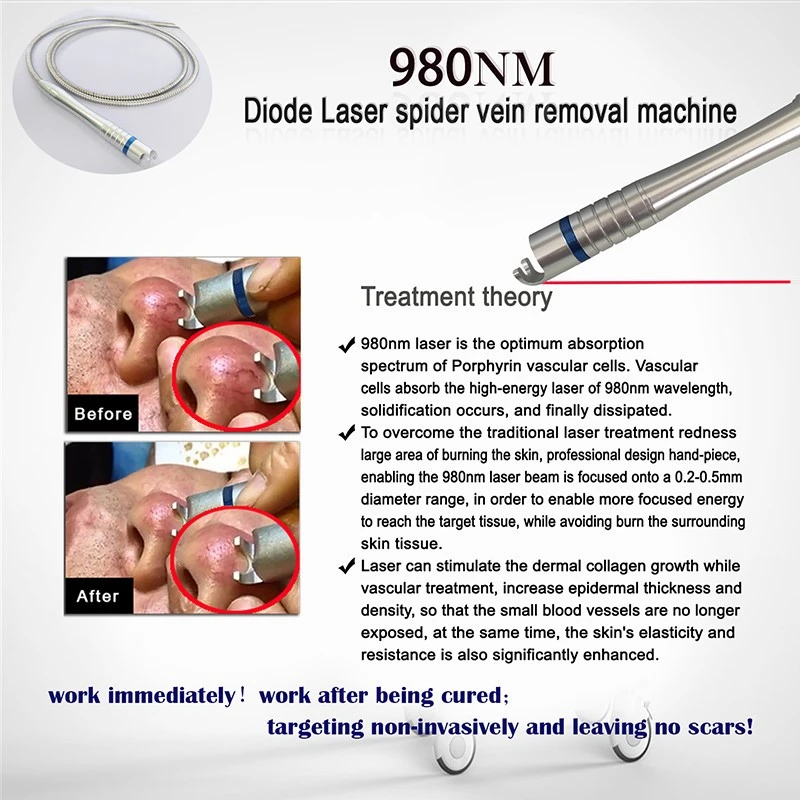 980nm-Diode-Laser11 980nm-Diode-Laser11