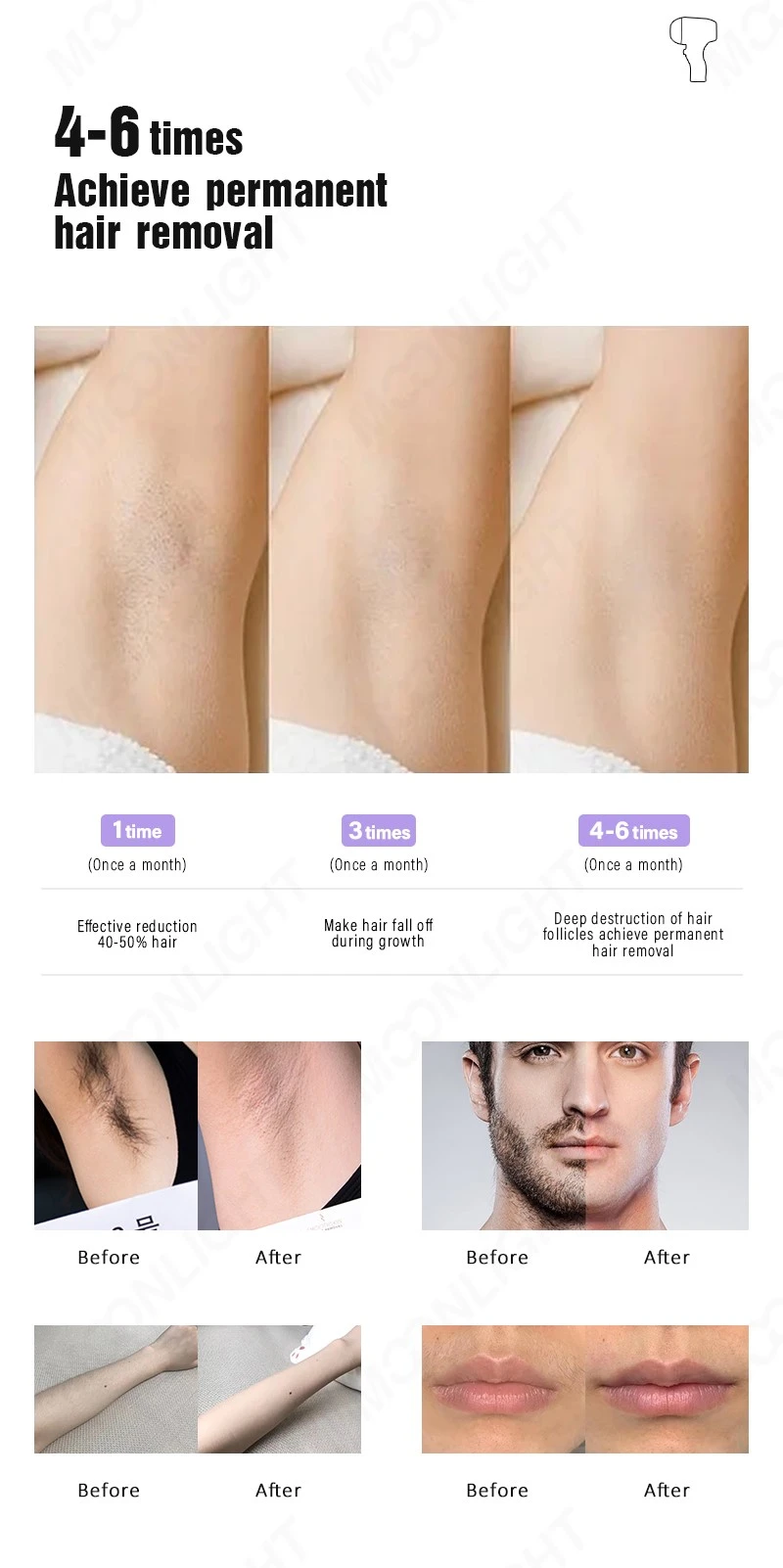 laser hair removal D2 12